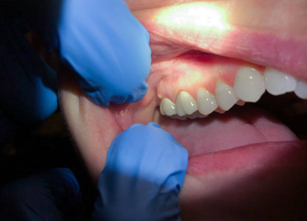Best Emergency Root Canal Treatment in Morgantown, MS