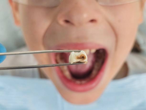 Best Emergency Wisdom Teeth Removal in Morgantown, MS